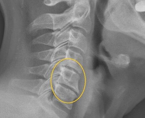 Dzemdes kakla mugurkaula osteohondroze uz x -ray