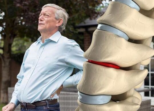 Osteohondroze ietekmē starpskriemeļu diskus un izraisa muguras sāpes