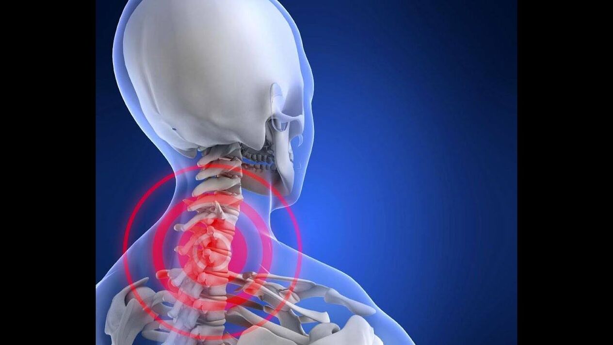 Dzemdes kakla mugurkaula osteohondroze